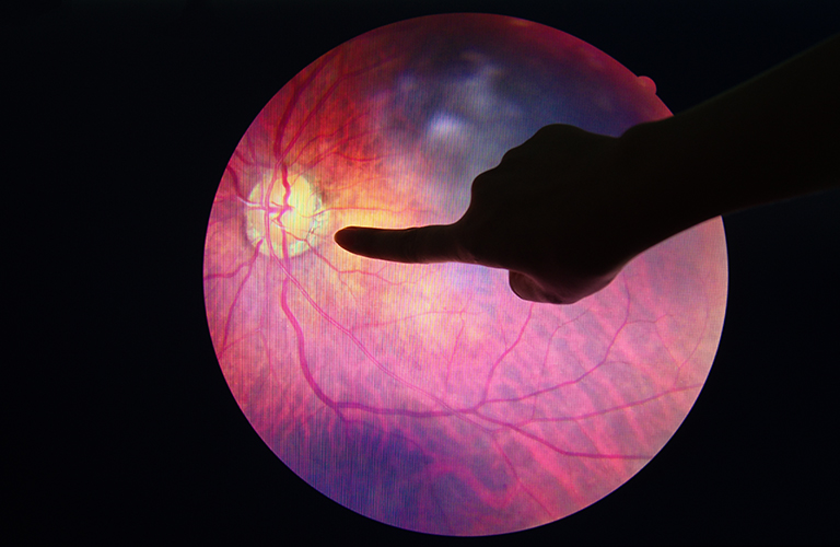 Retinitis pigmentoza | Očesne bolezni | Očesna Optika Vogrič